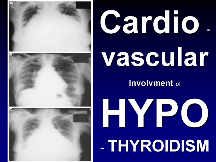 Thyroid Dysfunction And Heart Failure