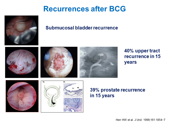 Recurrences After Bcg Activity Six Management Of T1 High Grade Bladder Cancer Educational 8495