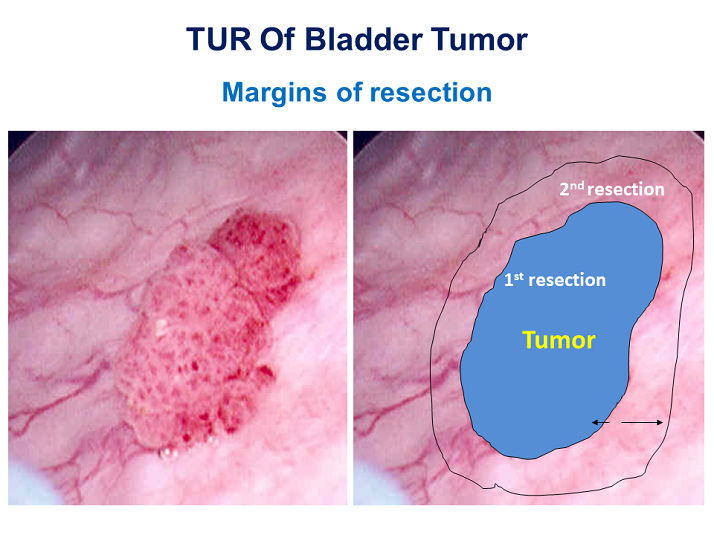 Bladder Cancer Grading