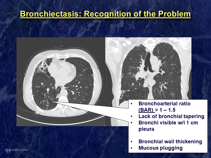 Bronchoarterial Ratio - Bronchiectasis: Emerging Trends And Unmet Needs ...