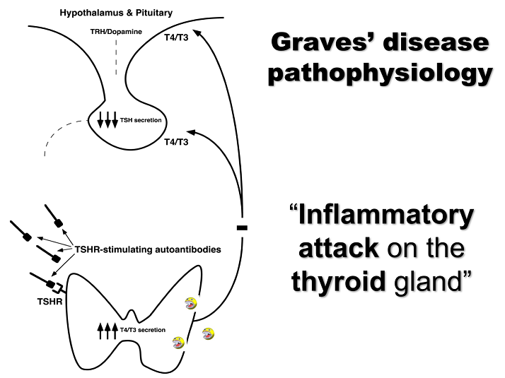 graves disease diagram
