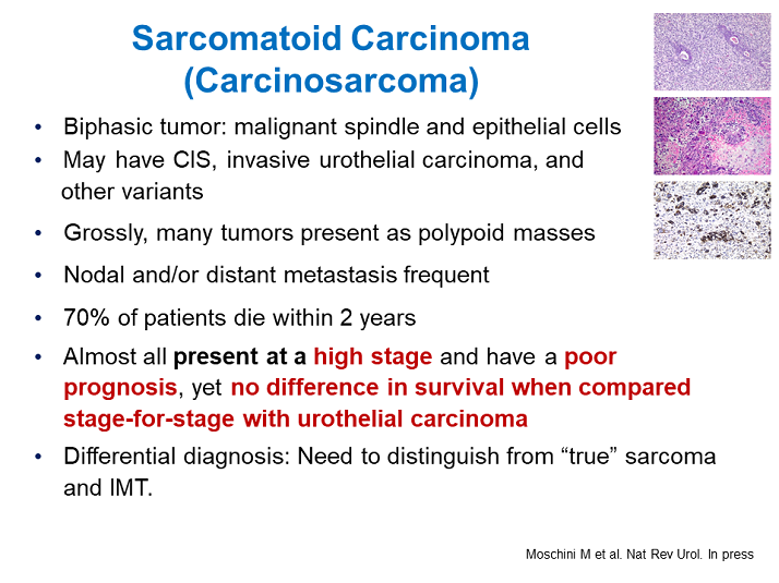 Sarcomatoid Carcinoma (Carcinosarcoma) - Activity Six: Management of T1 ...