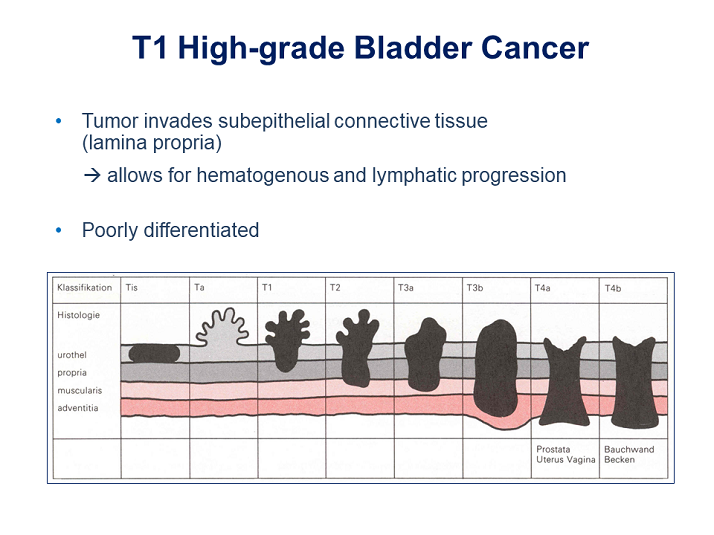 t1-high-grade-activity-six-management-of-t1-high-grade-bladder