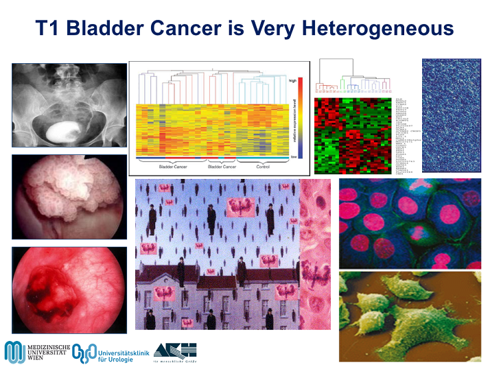 t1-bladder-cancer-is-very-heterogeneous-activity-six-management-of