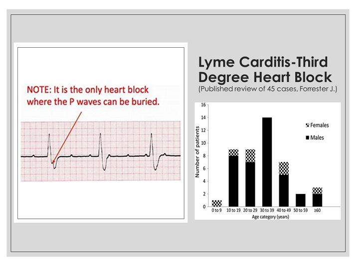 lyme-carditis-and-third-degree-heart-block-pediatric-lyme-disease