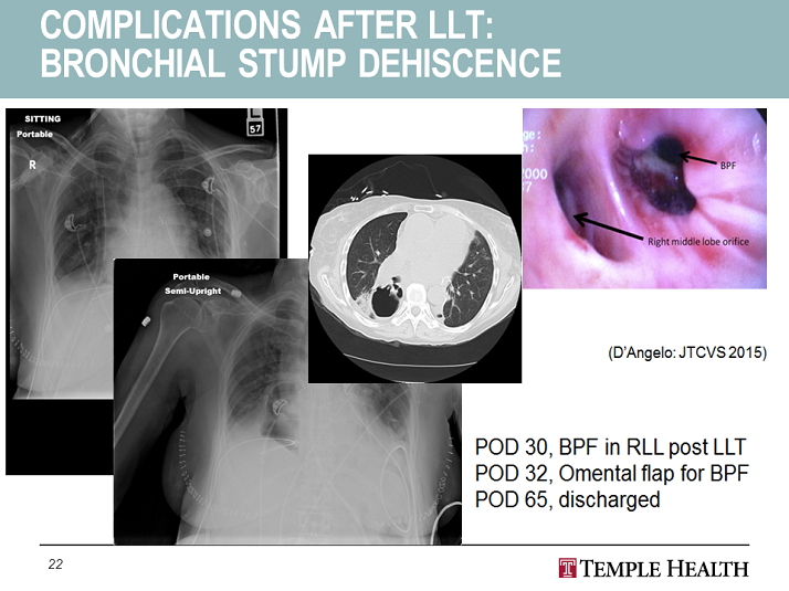 Complications after LLT: Bronchial Stump Dehiscence - Surgical Approach ...